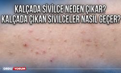 Kalçada sivilce neden çıkar? Kalçada çıkan sivilceler nasıl geçer?