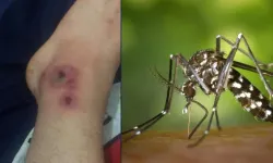 Asya kaplanı sivrisineği salgını nedir, belirtileri neler ve nasıl korunmak gerekir?