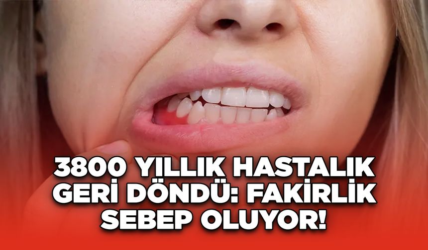 3800 Yıllık Hastalık Geri Döndü: Fakirlik Sebep Oluyor!