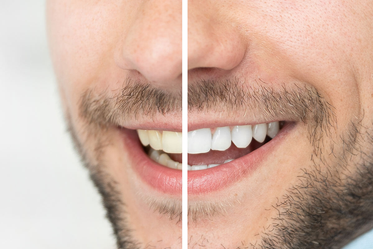 man-smiling-teeth-whitening